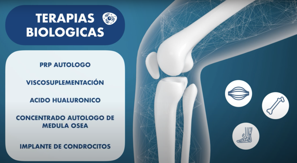 Terápias biológicas. PRP Autólogo. Viscosuplementación. Ácido Hialurónico. Concentrado autólogo de médula ósea. Implante de condrocitos. Medicina Regenerativa Imatde Arthrosport Málaga